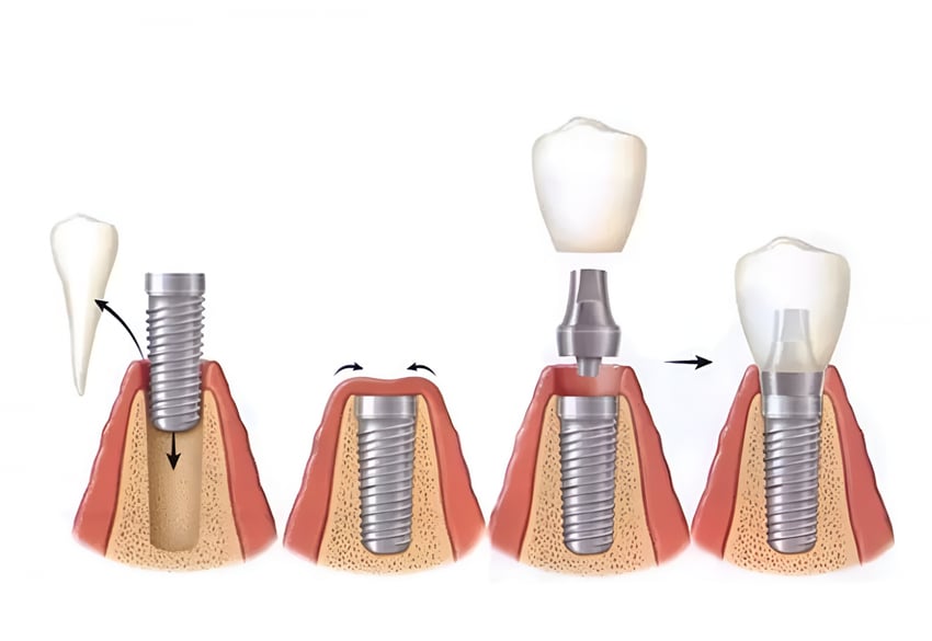 Dental implant preparation process for diabetic patients at Smile Center Turkey