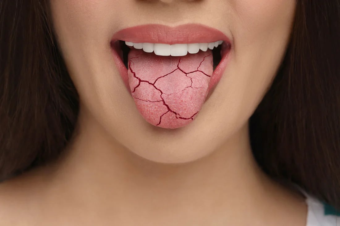 drymouth 1