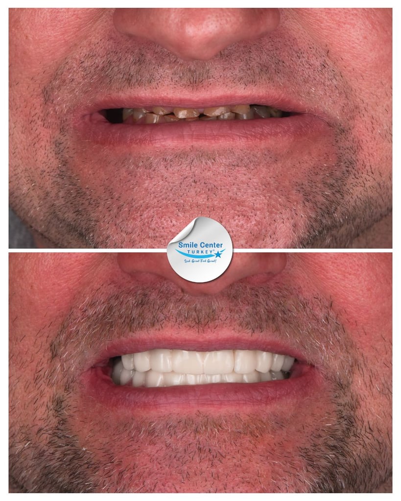Before and after close-up of a man’s mouth showing heavily stained and missing teeth before treatment and a full set of white teeth after dental restoration at Smile Center Turkey.