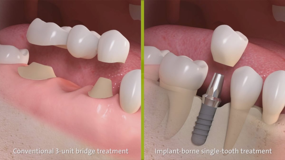 Comparison of dental bridge and dental implant side by side