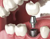 Healing and osseointegration after full-mouth implants