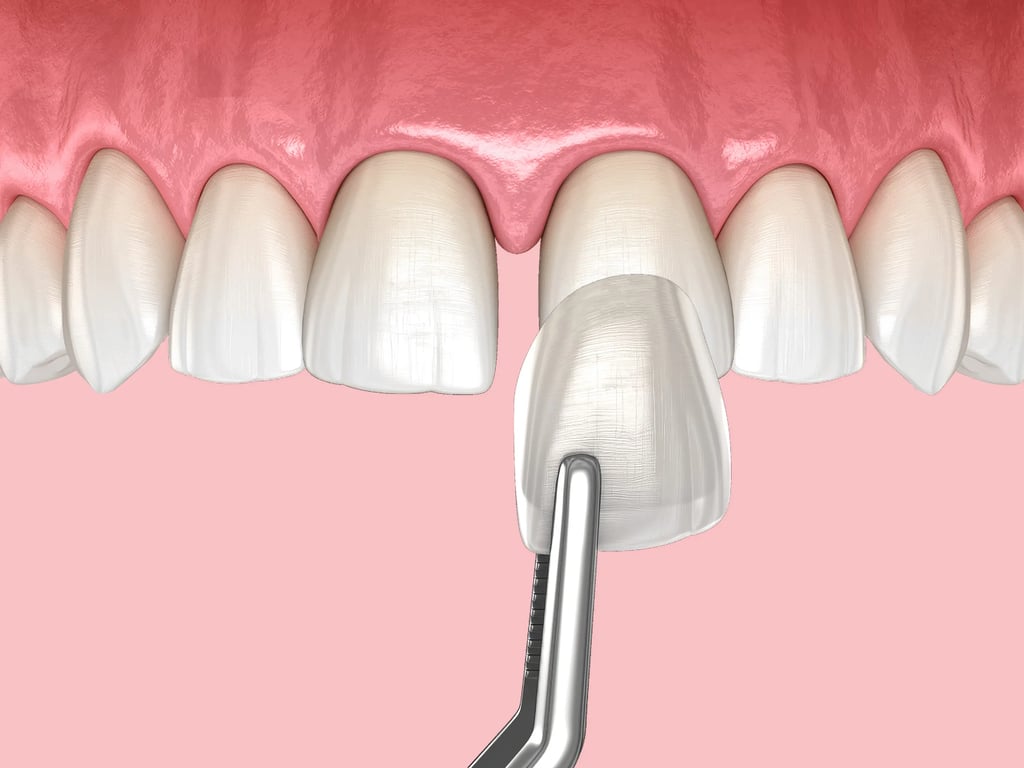 Close-up of gap teeth with a dental tool applying a veneer