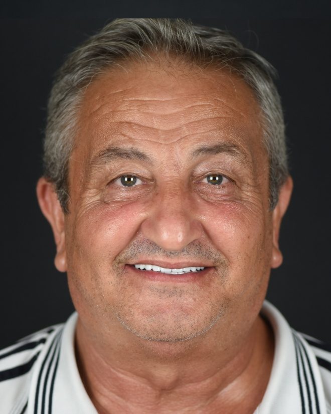 Smile Gallery – Smile Center Turkey®