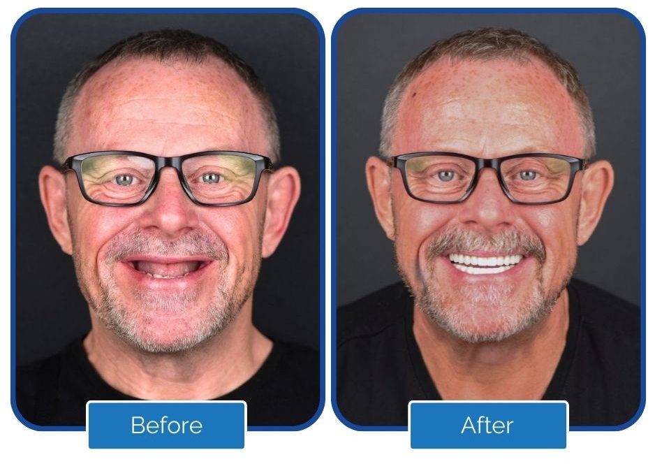 Before and after dental implant treatment showing natural smile transformation in Turkey 2026