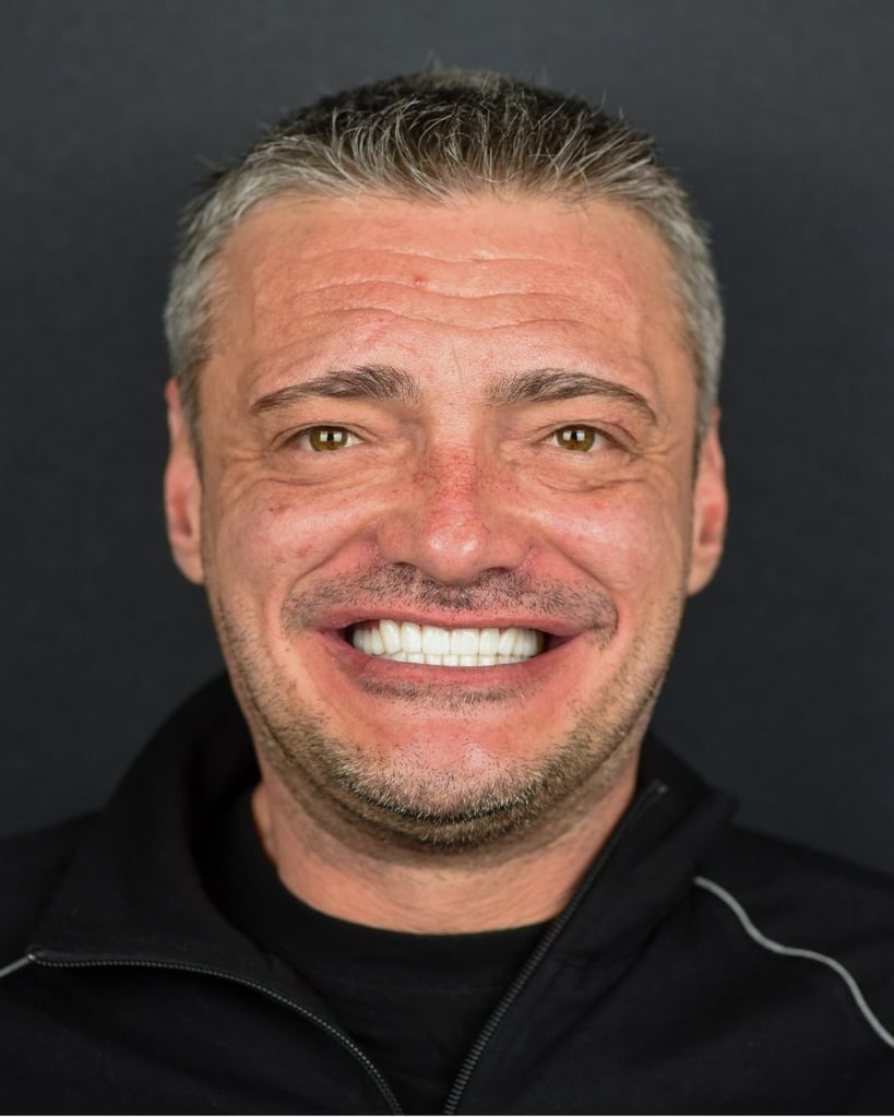 Smile Makeover Gallery – Smile Center Turkey®