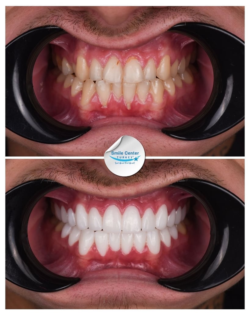 Alfred W. – Smile Center Turkey®