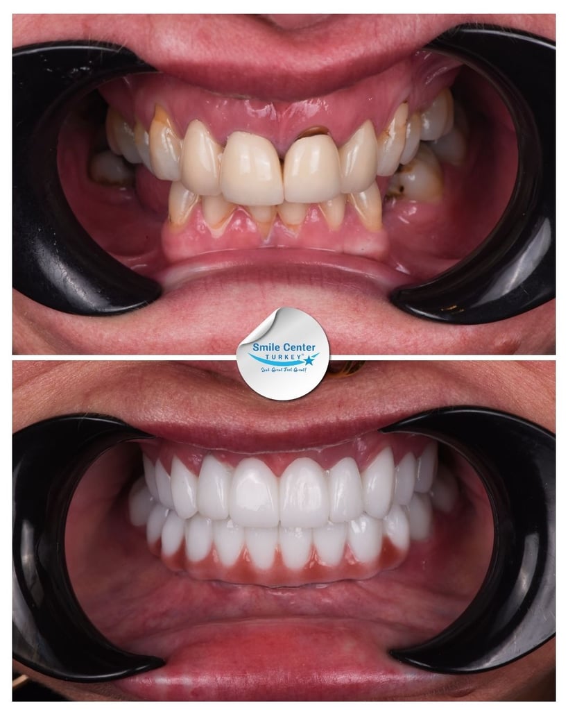 Toni M. – Smile Center Turkey®