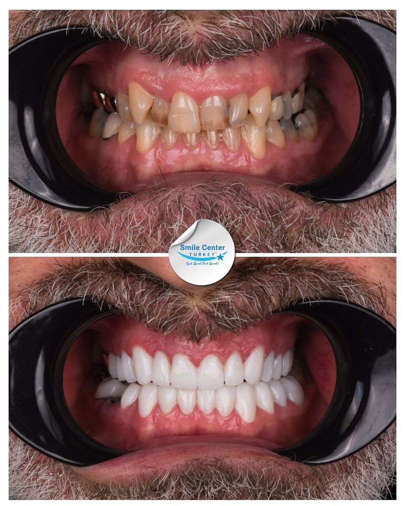 Nicholas K. – Smile Center Turkey®