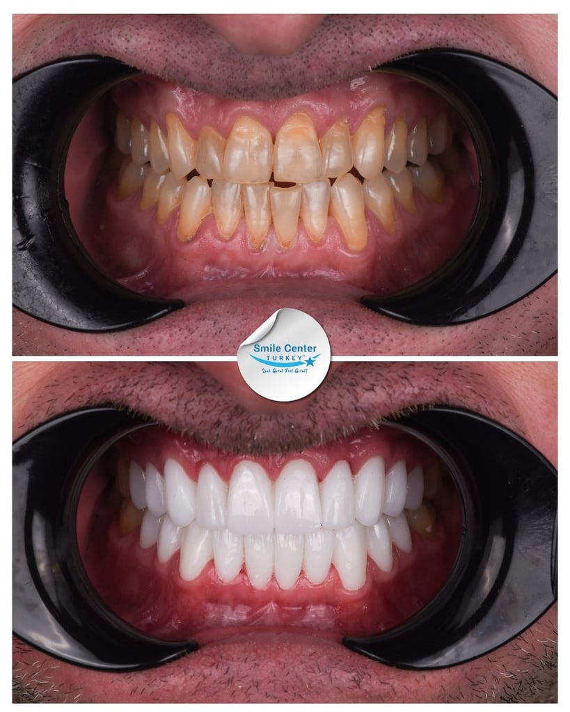David H. – Smile Center Turkey®