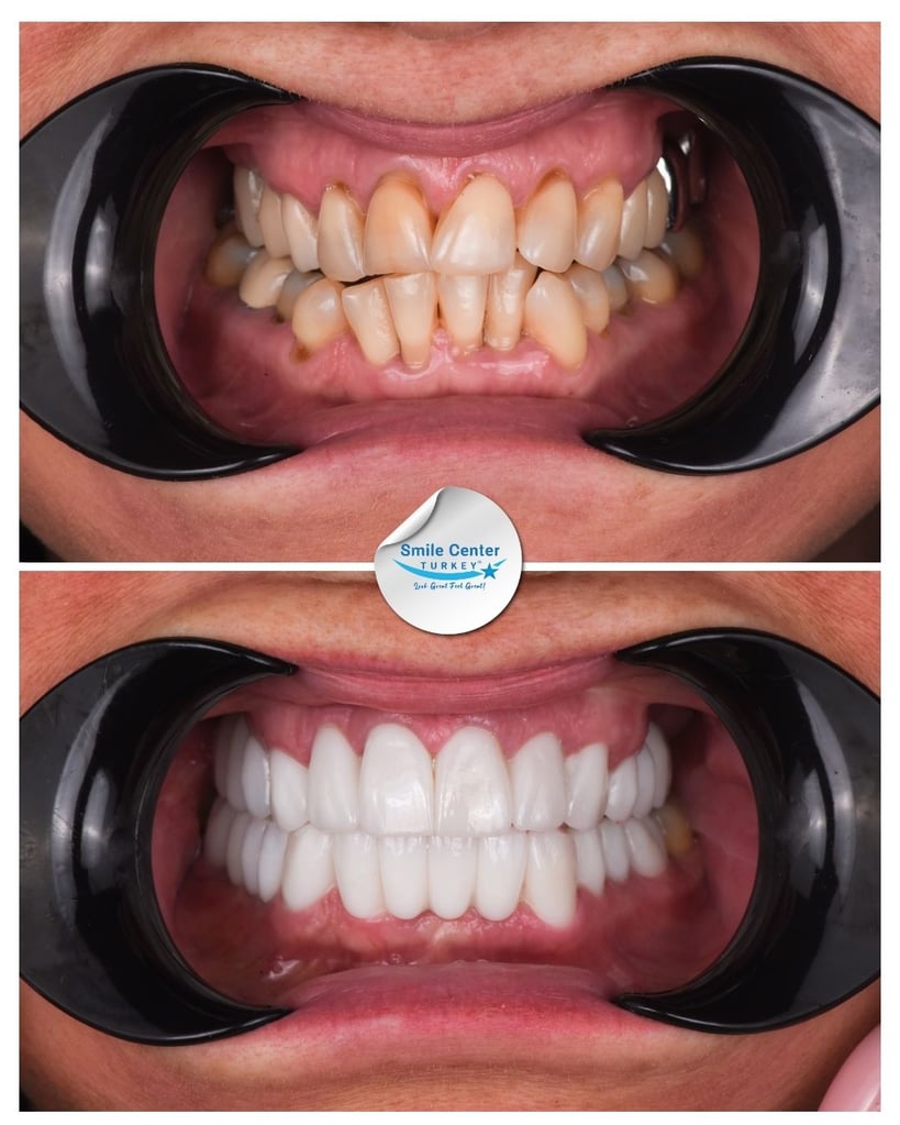 Tatjana L. – Smile Center Turkey®