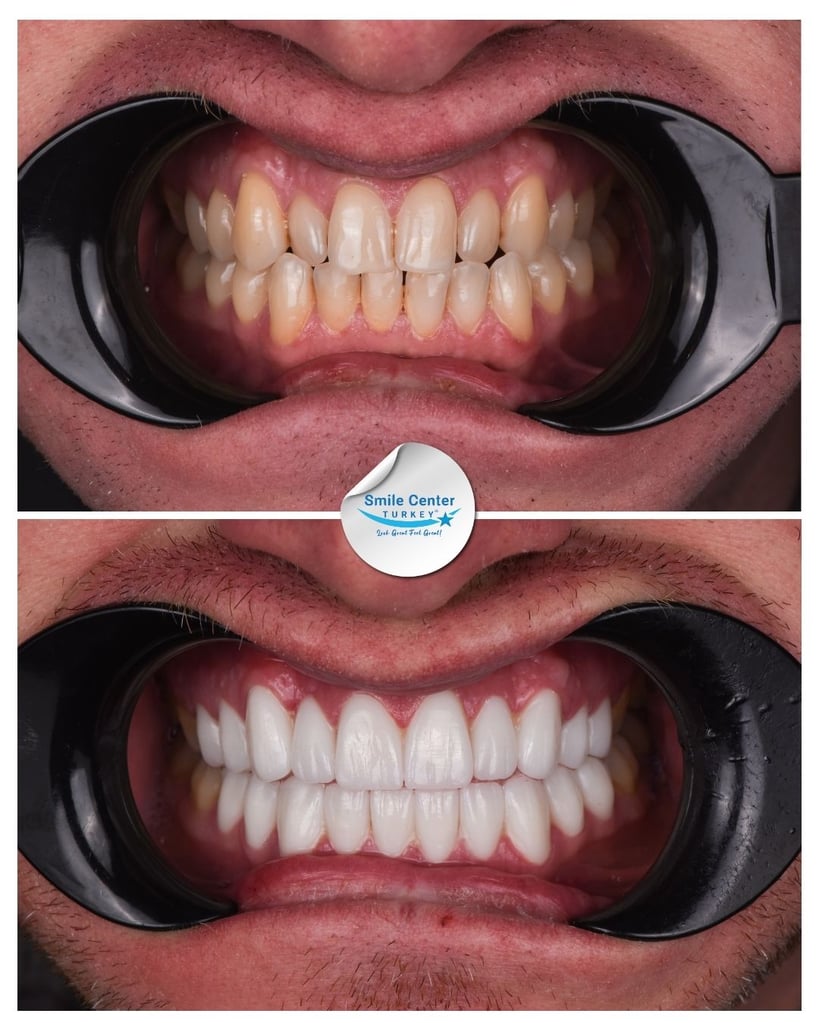 Sandra B. – Smile Center Turkey®