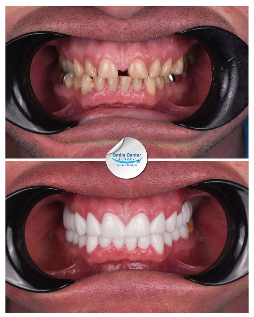 Dwayne O. – Smile Center Turkey®