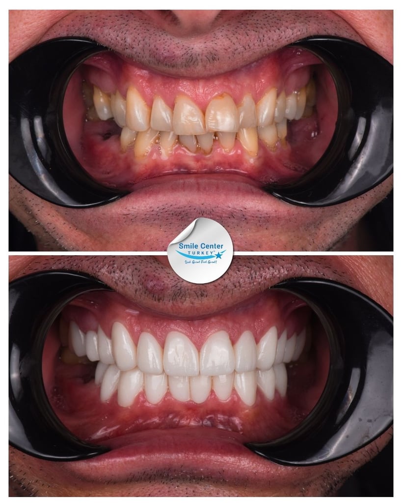Jason F. – Smile Center Turkey®