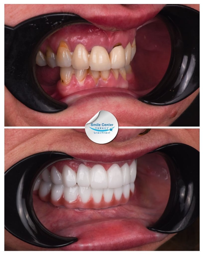 Toni M. – Smile Center Turkey®