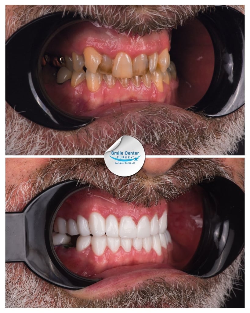 Nicholas K. – Smile Center Turkey®