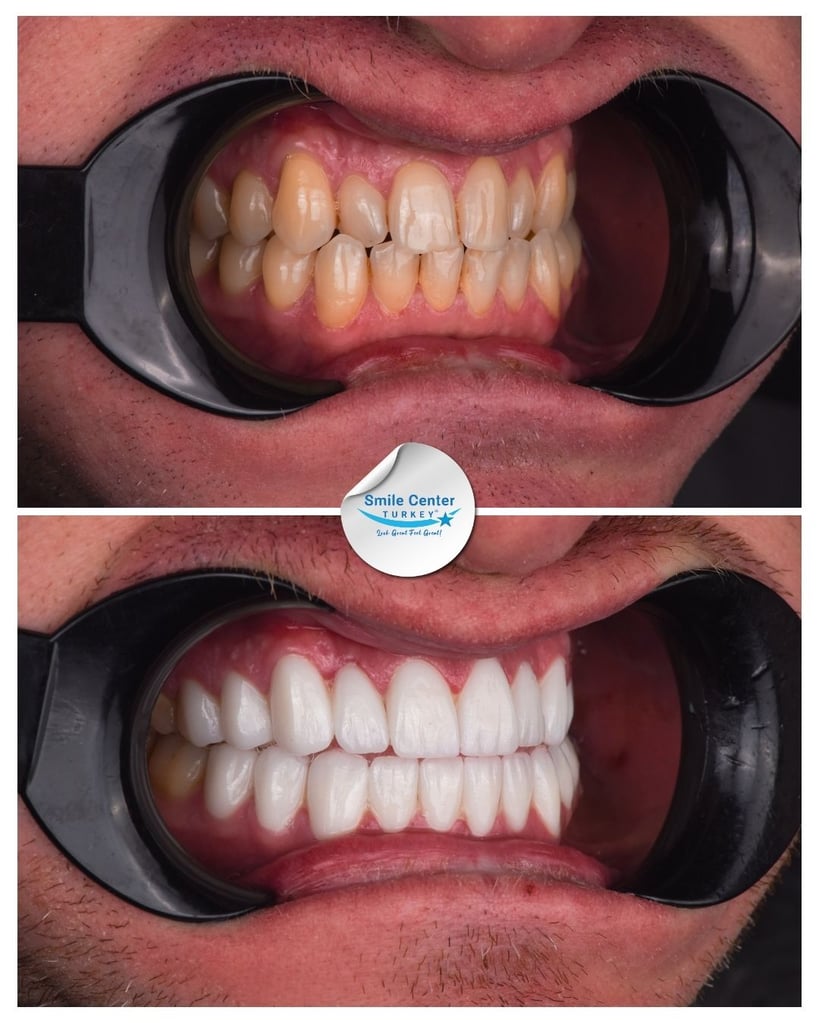 Sandra B. – Smile Center Turkey®