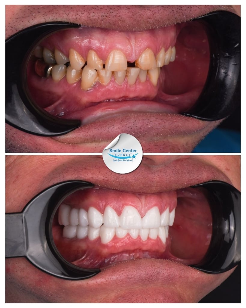 Dwayne O. – Smile Center Turkey®