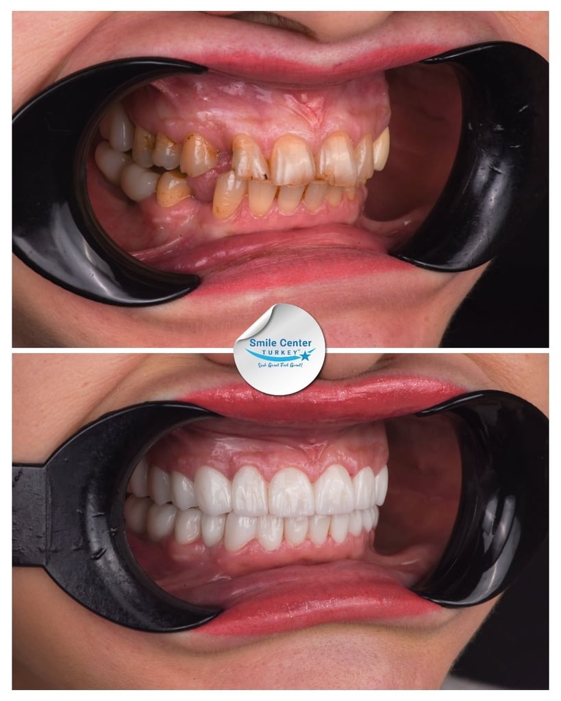 Nicolae S. – Smile Center Turkey®