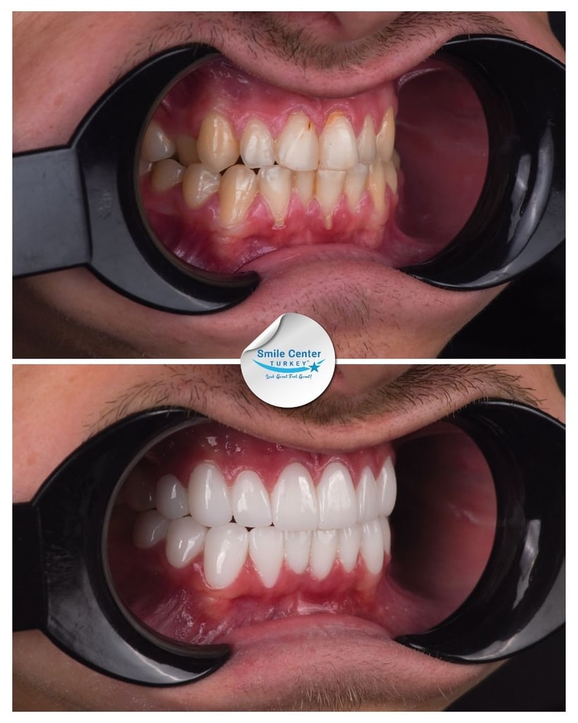Alfred W. – Smile Center Turkey®