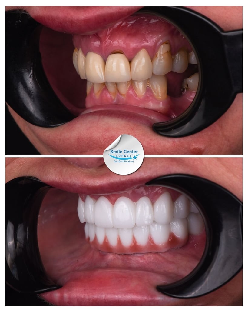 Toni M. – Smile Center Turkey®