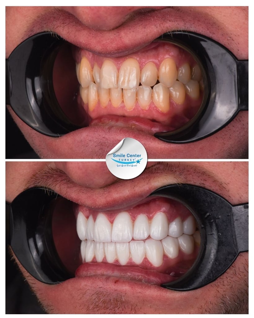 Sandra B. – Smile Center Turkey®