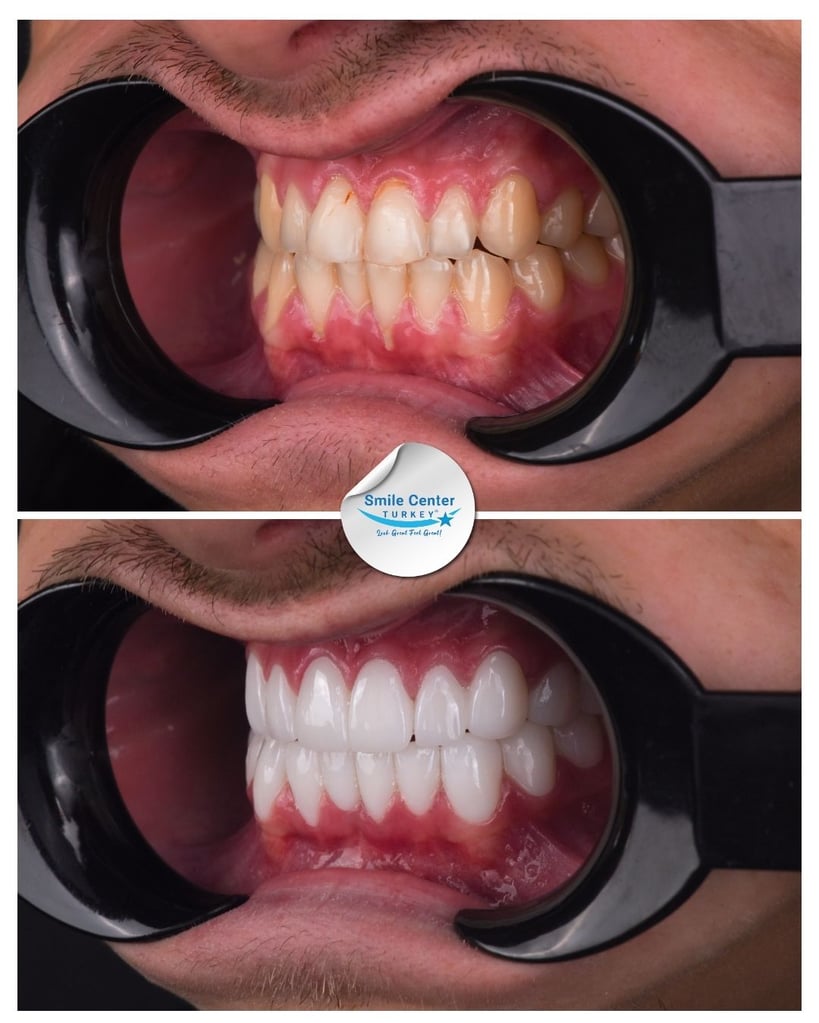 Alfred W. – Smile Center Turkey®