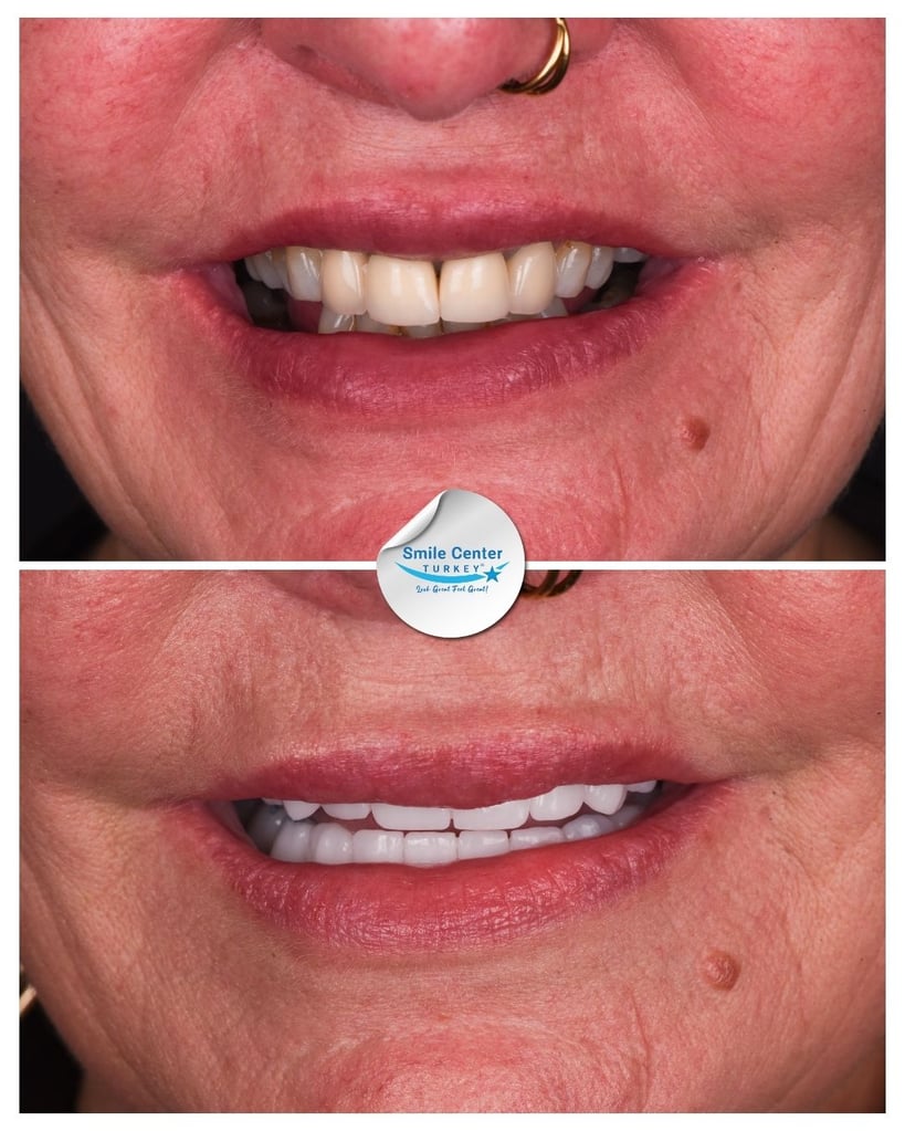 Toni M. – Smile Center Turkey®