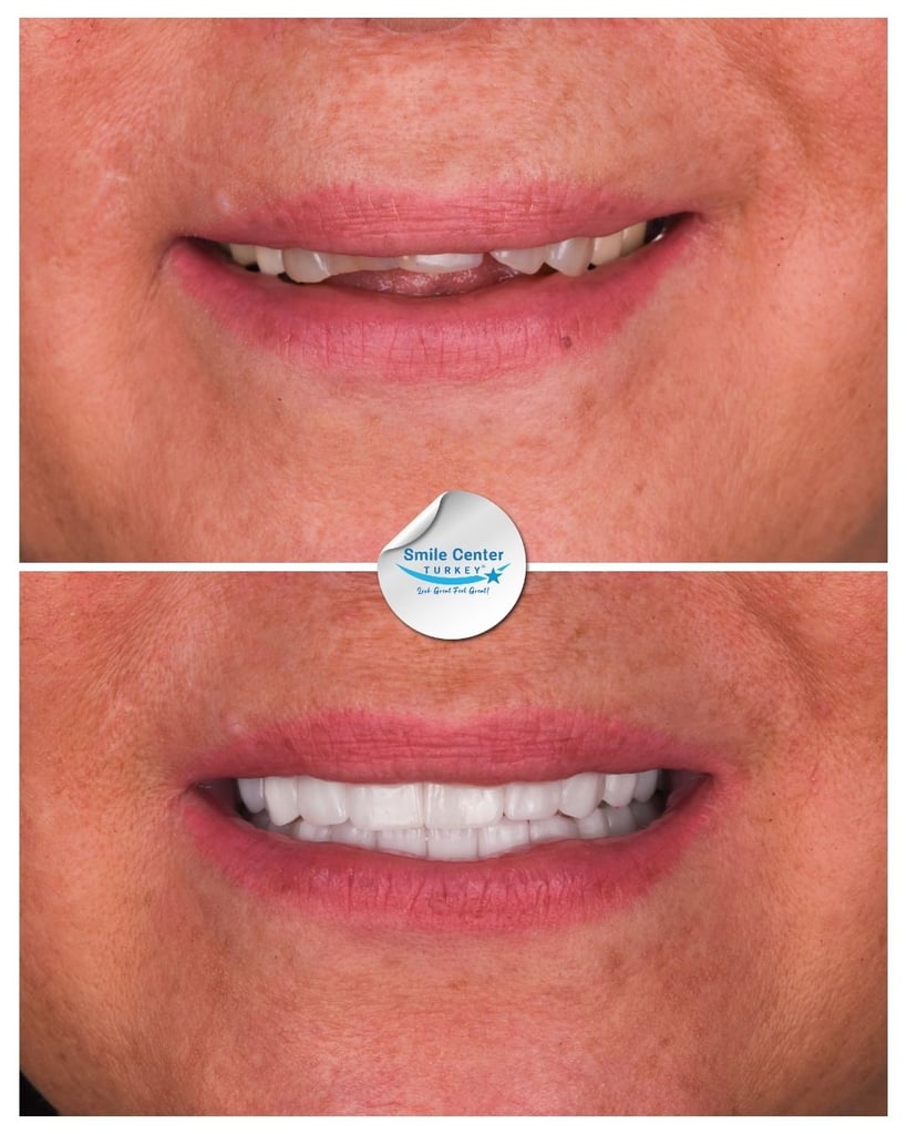 Tatjana L. – Smile Center Turkey®
