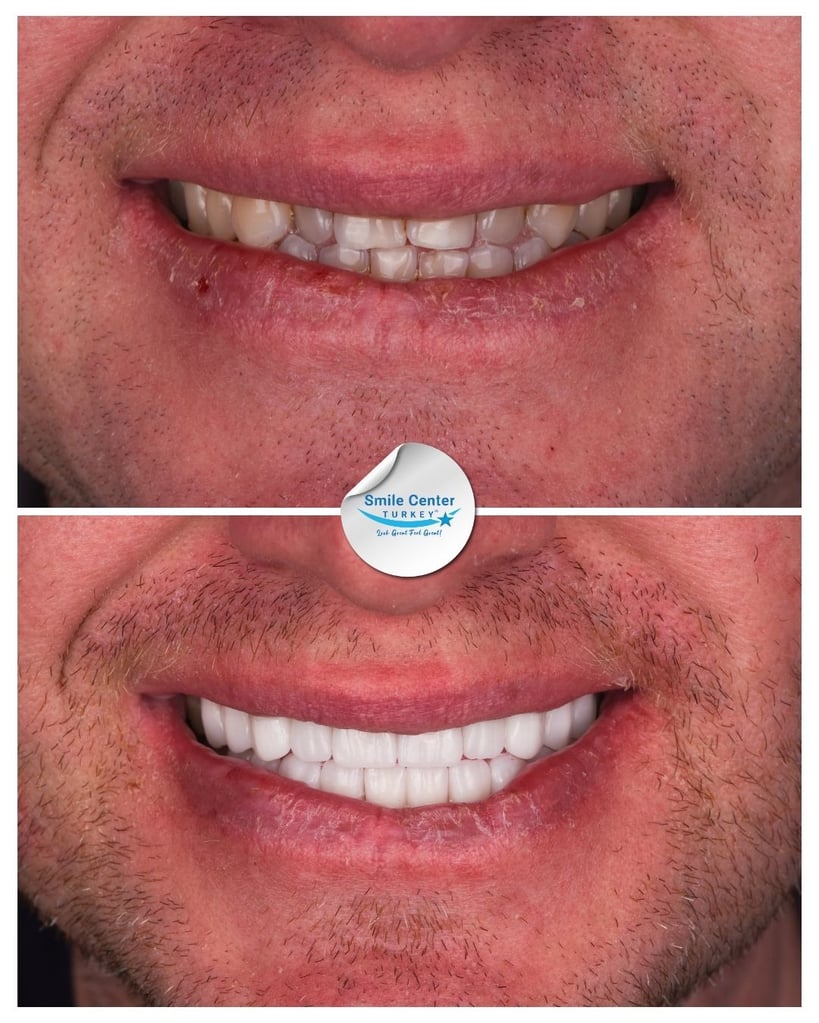 Sandra B. – Smile Center Turkey®