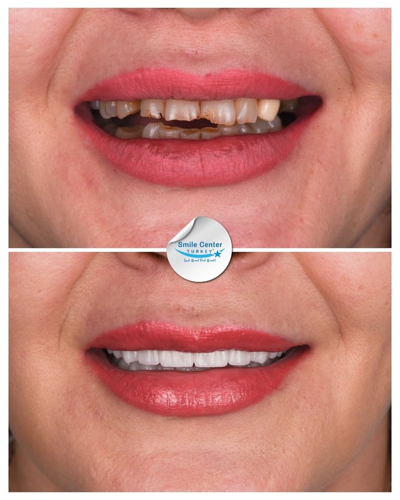 Nicolae S. – Smile Center Turkey®