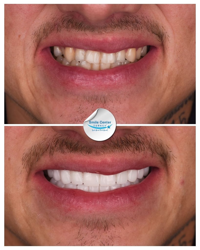 Alfred W. – Smile Center Turkey®