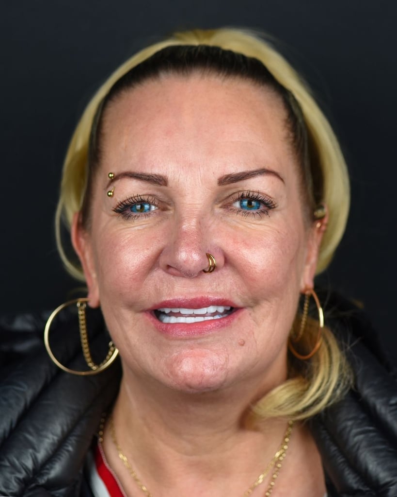 Smile Makeover Gallery – Smile Center Turkey®