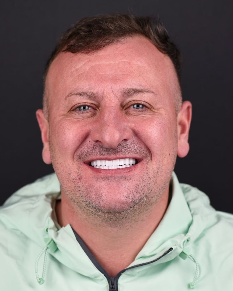 Smile Makeover Gallery – Smile Center Turkey®