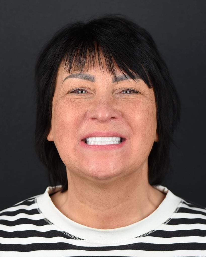 Smile Makeover Gallery – Smile Center Turkey®