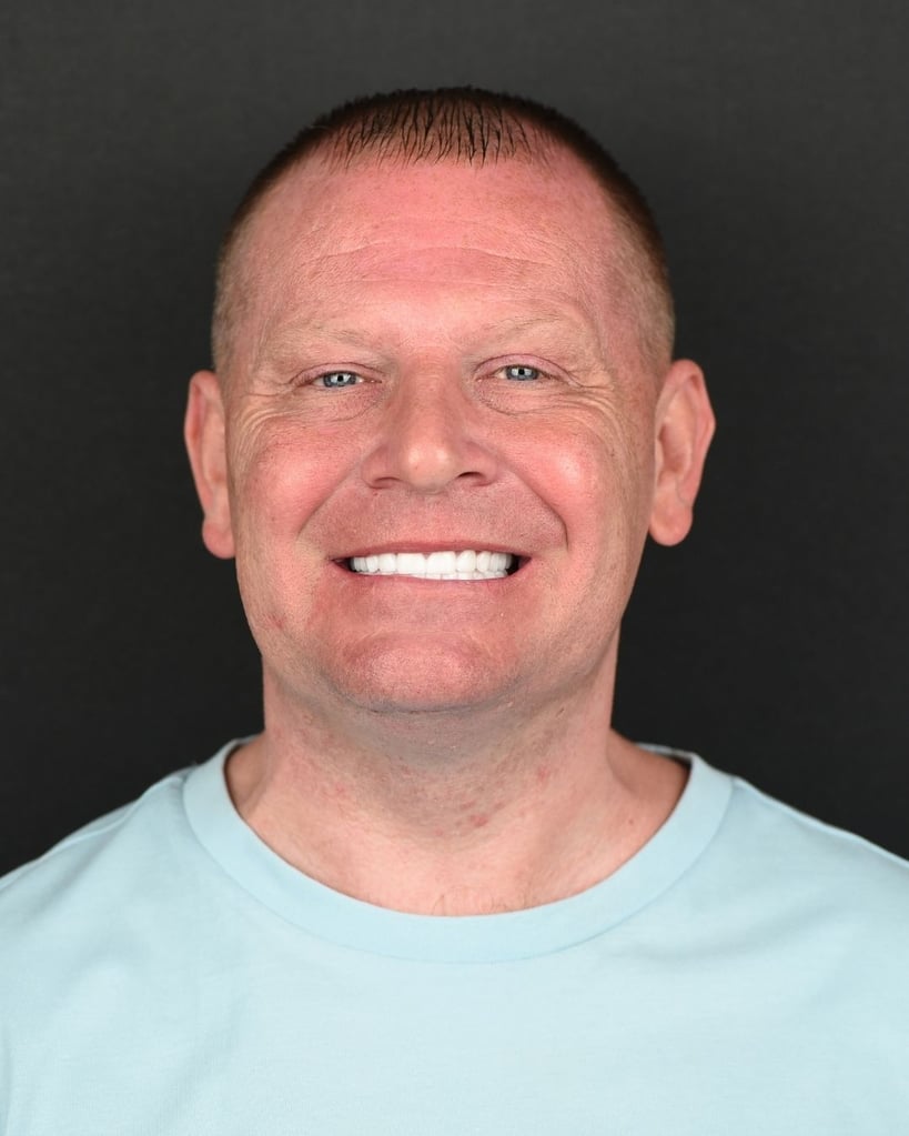 Smile Makeover Gallery – Smile Center Turkey®