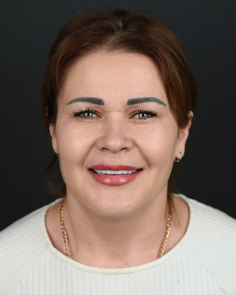 Smile Makeover Gallery – Smile Center Turkey®