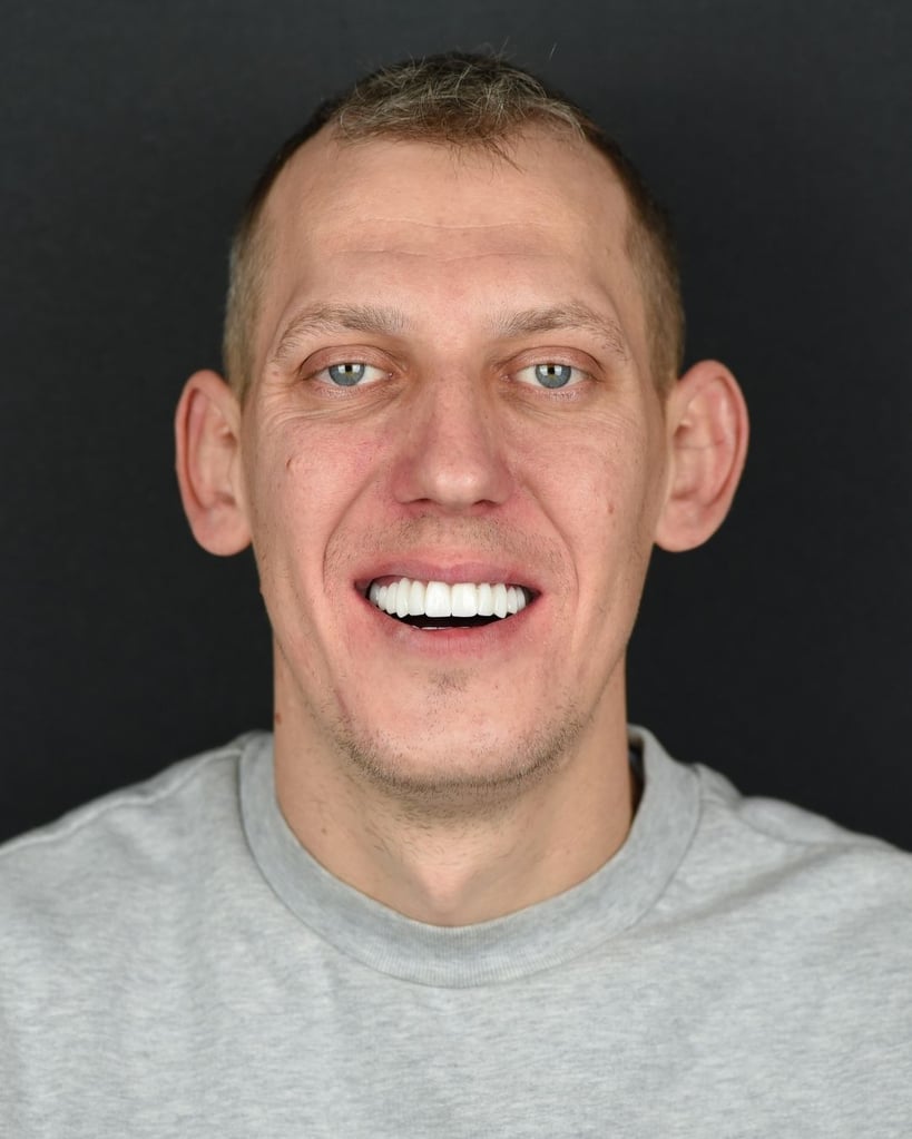 Smile Makeover Gallery – Smile Center Turkey®