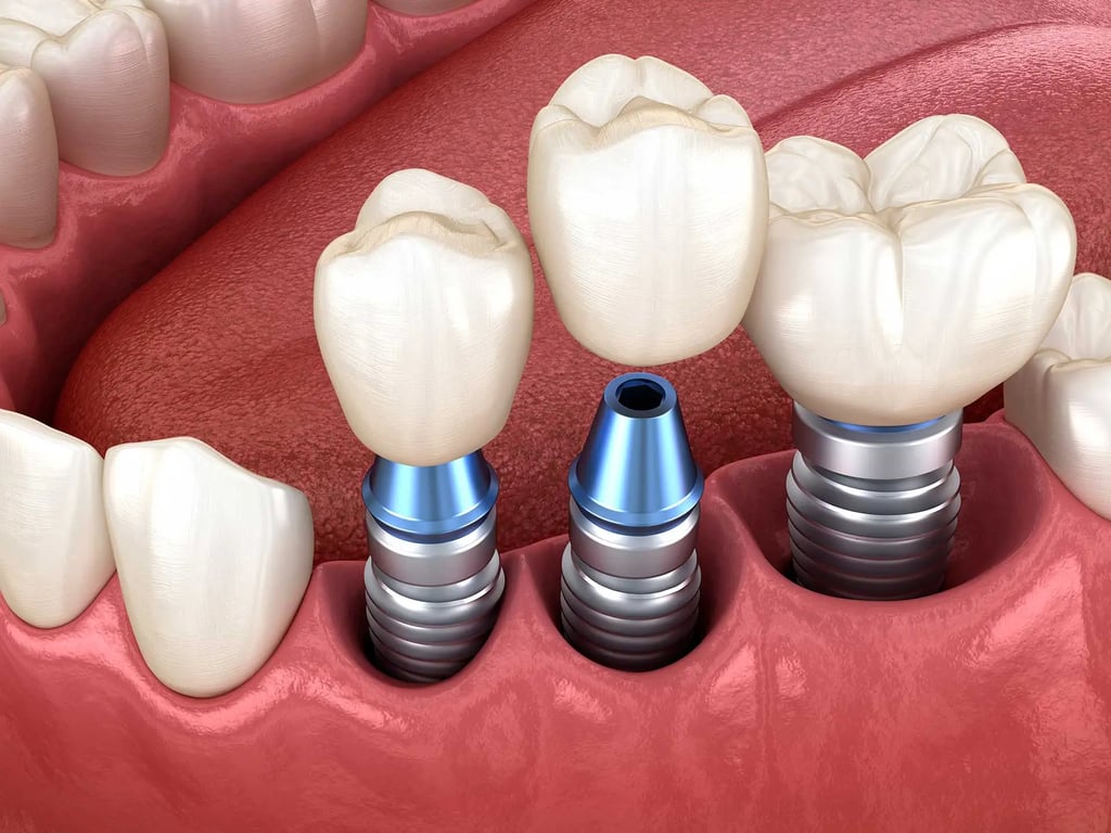 dental implants turkey