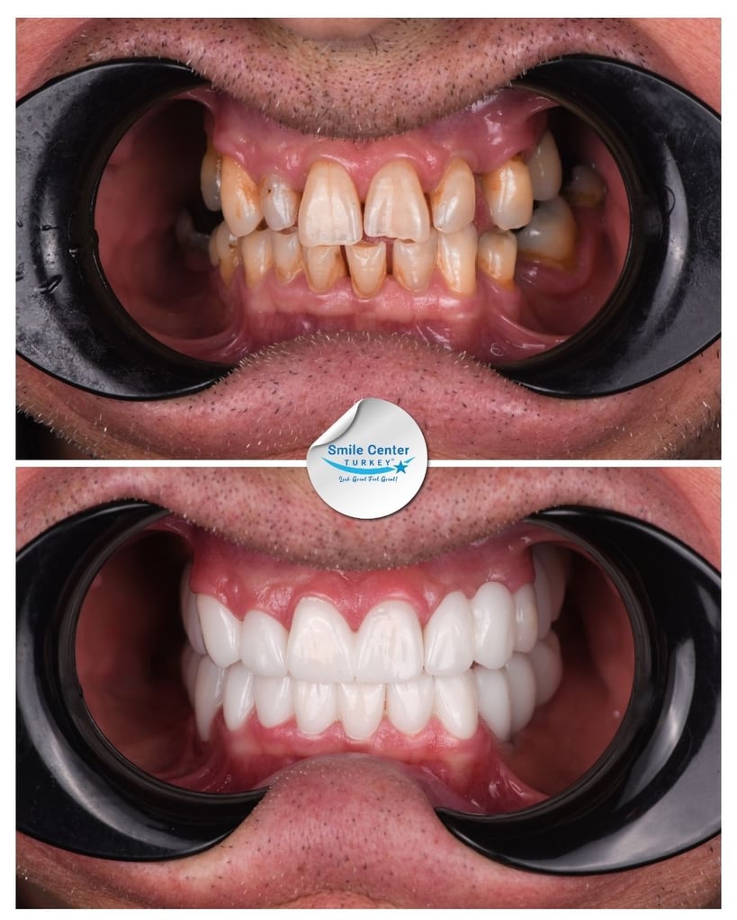 John K. – Smile Center Turkey®