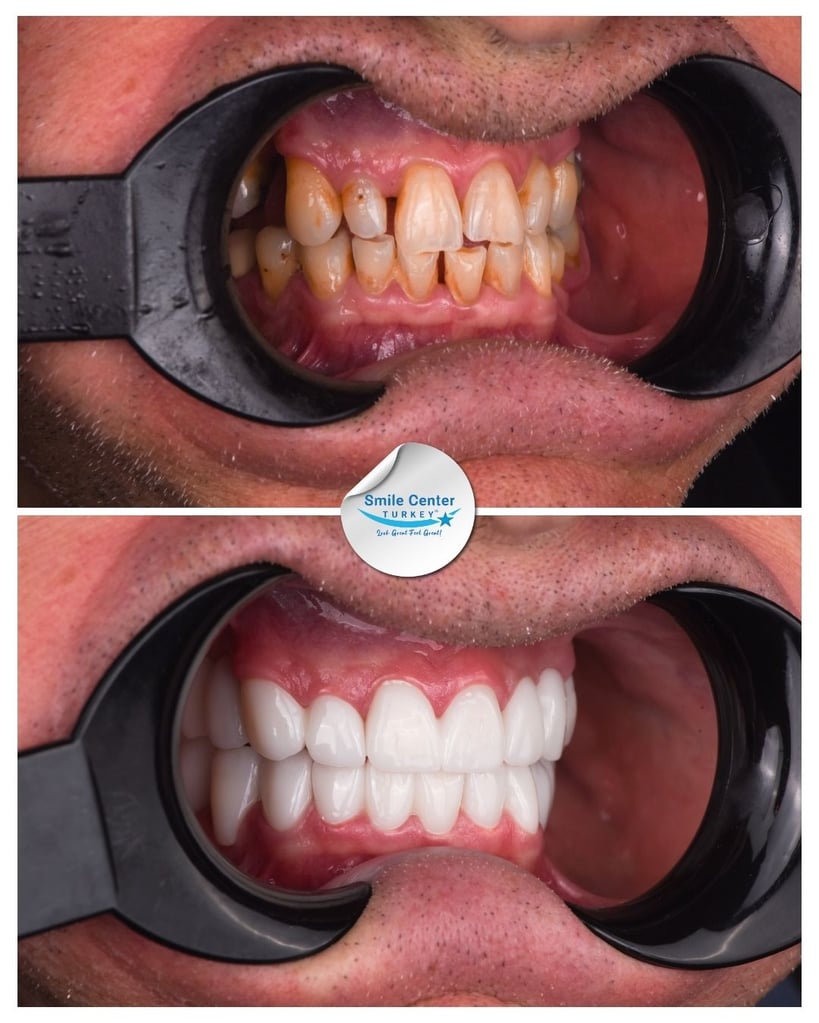 John K. – Smile Center Turkey®