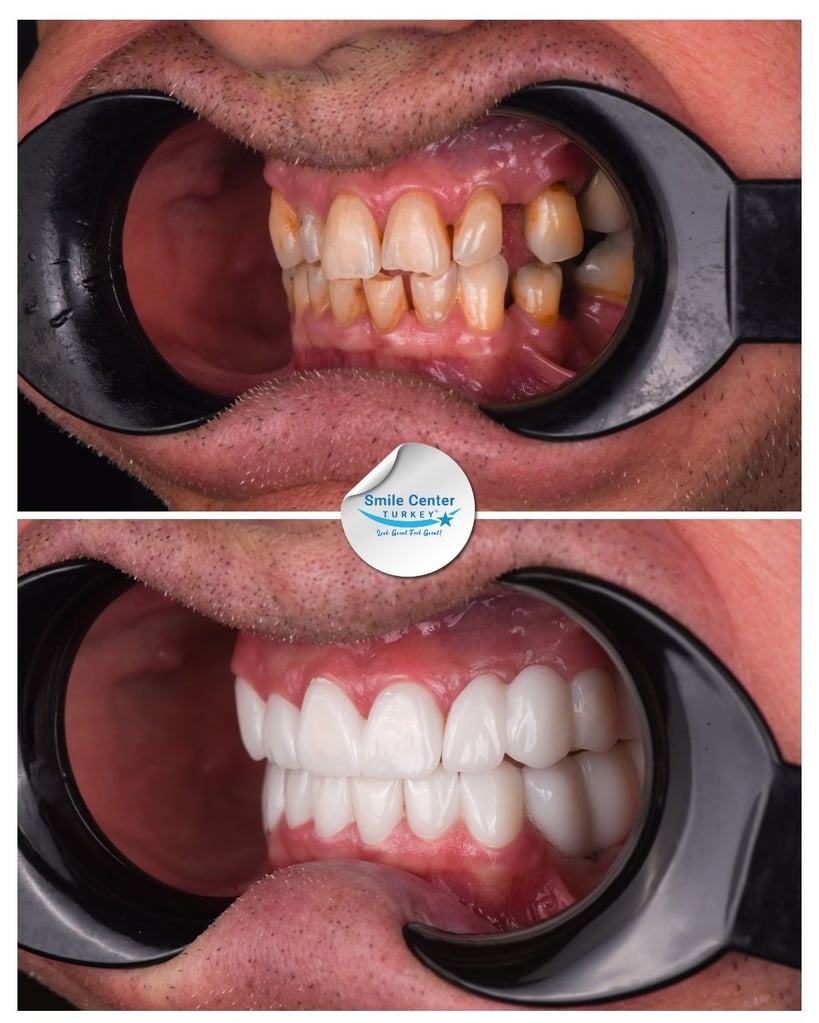 John K. – Smile Center Turkey®