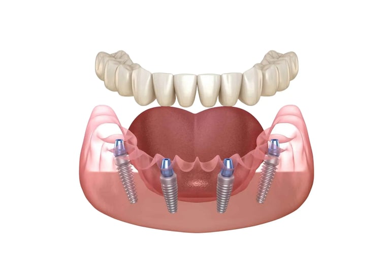 All-on-4 dental implants illustration