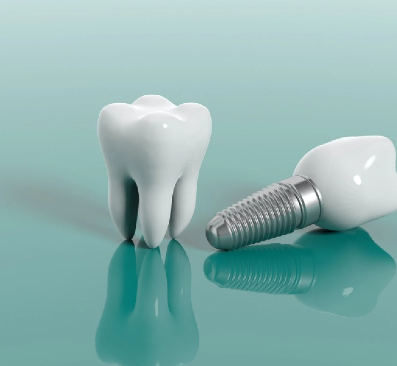 Dental implant illustration showing screw placement and prosthetic tooth structure