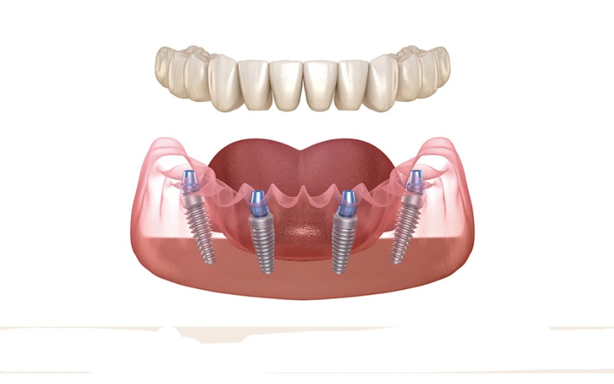 All-on-4 dental implant system illustration – full arch teeth on 4 implants