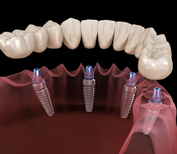Dental Treatment Turkey