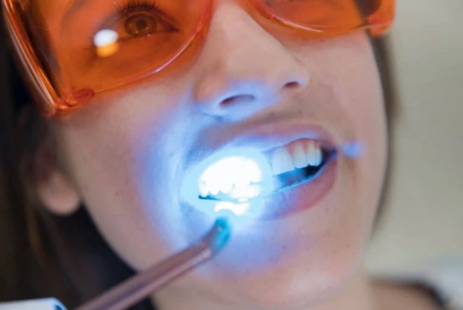 Teeth Whitening Procedure