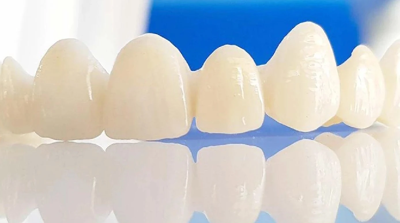 Close-up of zirconia dental crowns used in smile makeovers – Turkey