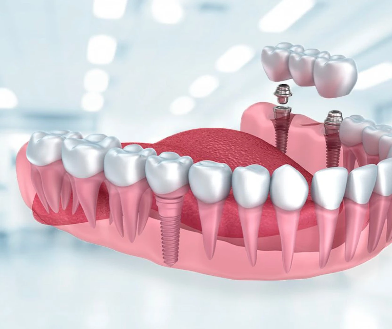 dental-implants-turkey