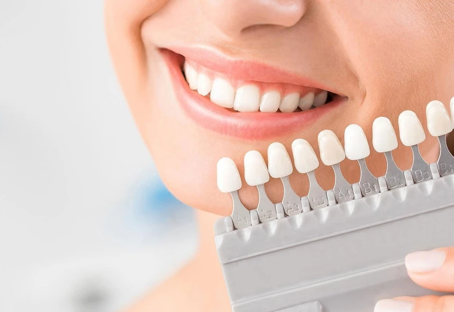 Teeth whitening treatment in Turkey using shade guide comparison