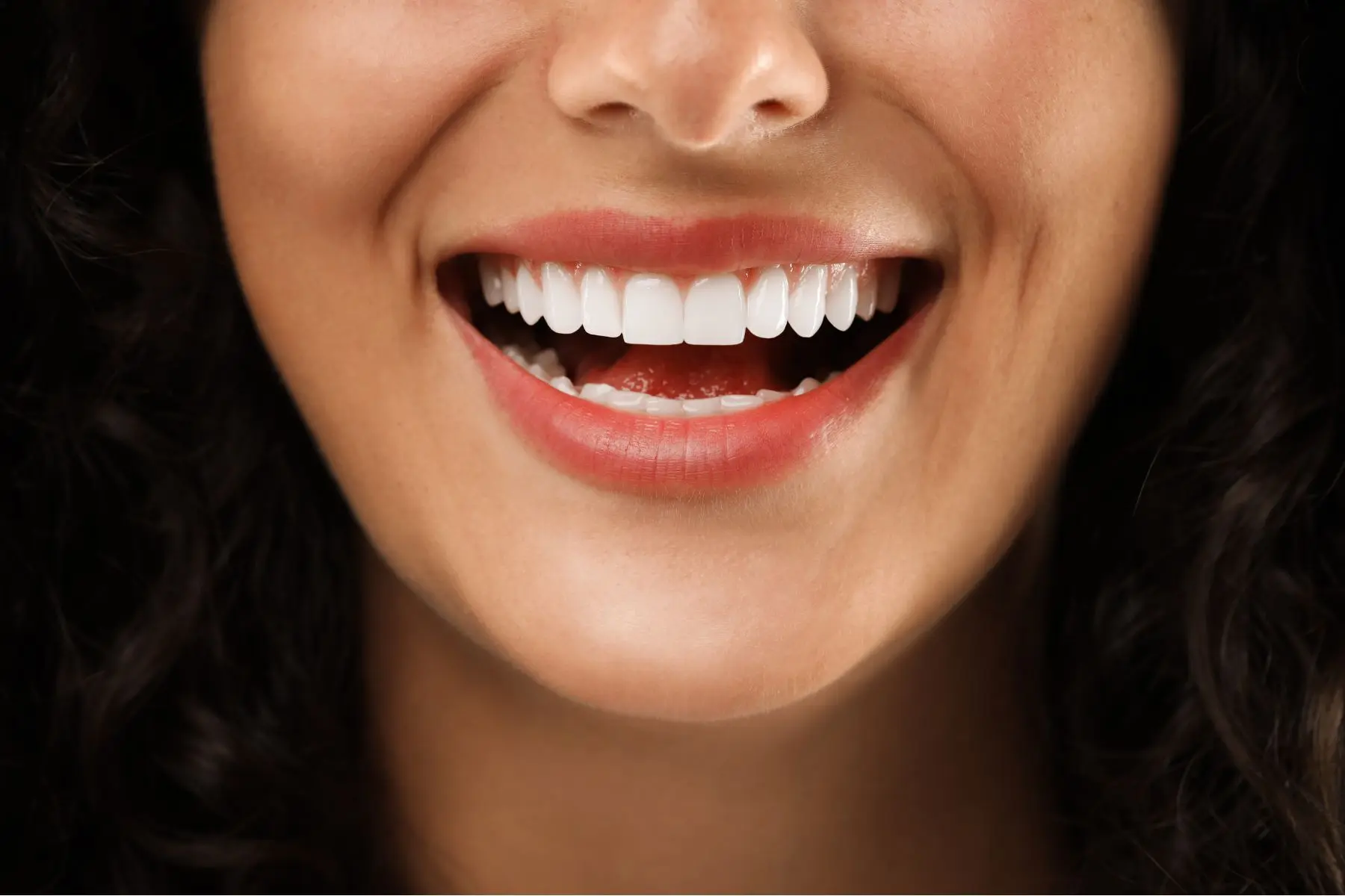 Hollywood Smile makeover result with veneers and whitening performed at Smile Center Turkey